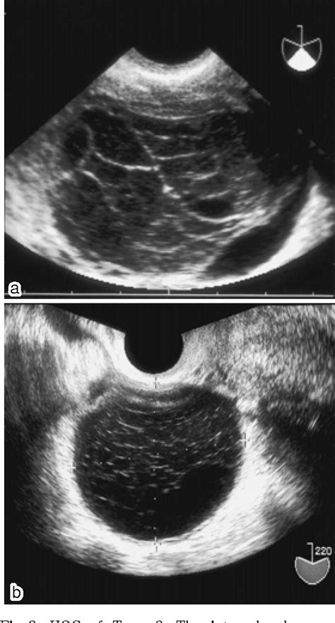 Hemorrhagic Ovarian Cyst Semantic Scholar