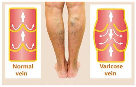Yoga Poses And Exercises For Varicose Veins Treatment