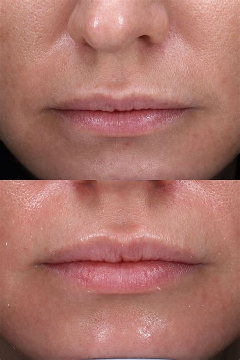What To Expect After Botox Lip Flip