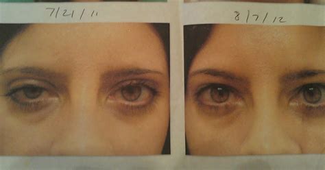 Congenital Ptosis Surgery Before And After Gallery