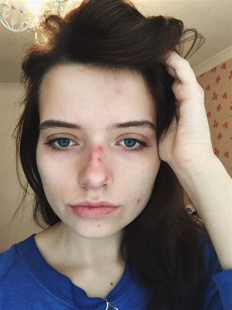 My Accutane Diary Beforeafter Monalogue