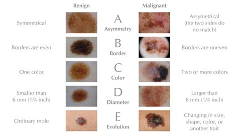 Know Your Abcdes Aim At Melanoma Foundation