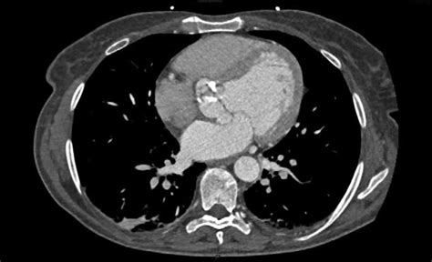 Extended Aortic Valve Calcification At Ct Chest Scan Download