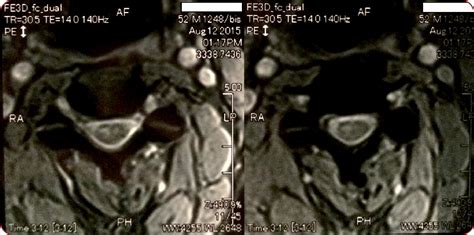 T2 Weighted Axial Mri Of Cervical Spine Showing An Intramedullary