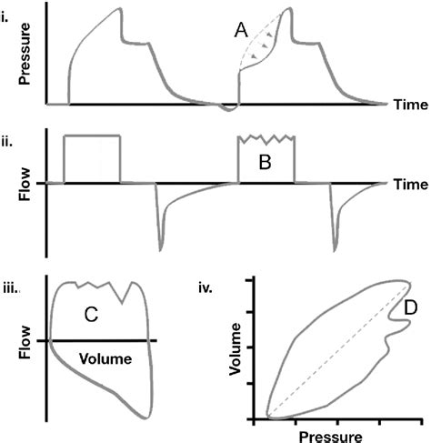 An edition of rapid interpretation of ventilator waveforms (2006). Figure 2 from Ventilator waveforms. - Semantic Scholar