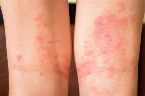 Dermatite Atopica Rimedi Naturali Efficaci Secondamano