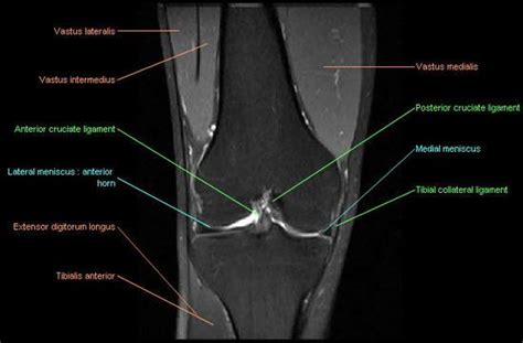 Knee Joint Mri Anatomy