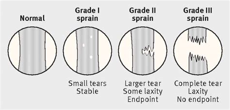 Grade 2 Ligament Tear Recovery Time Anterior Cruciate Ligament Acl