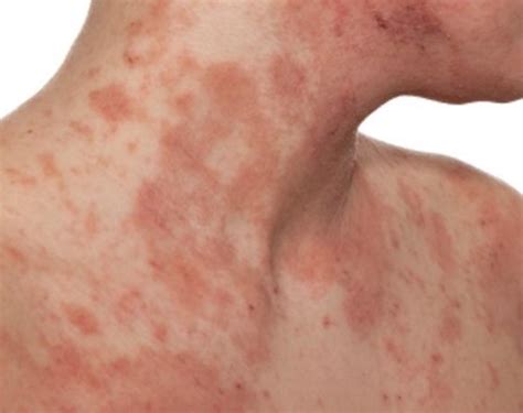 What Causes Itchy Rash All Over Body New Health Advisor