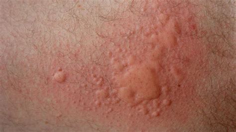 Contagious Skin Rashes That Itch