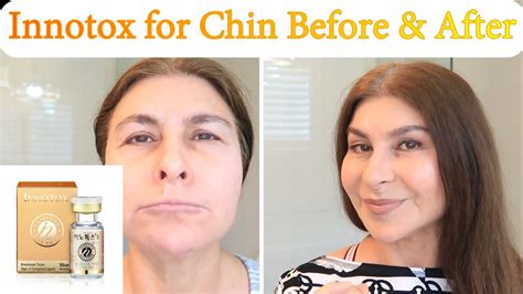 Innotox For Orange Peel Chin Units Marking Before And After Pdo