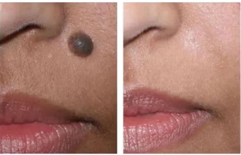 Laser Mole Removal For Facial Mole Removal Or Cosmetic Mole Removal