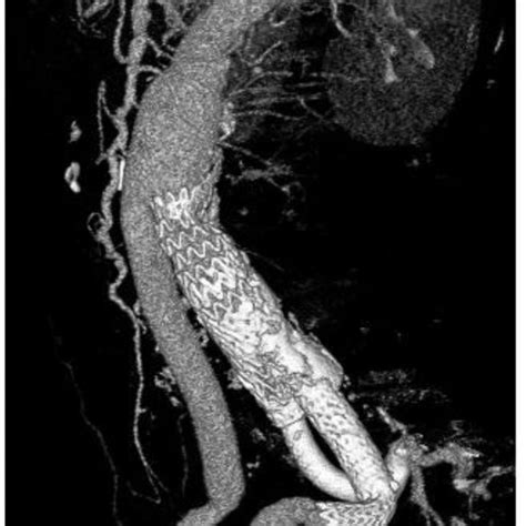 Preoperative Three Dimensional Computed Tomography Angiogram Depicting