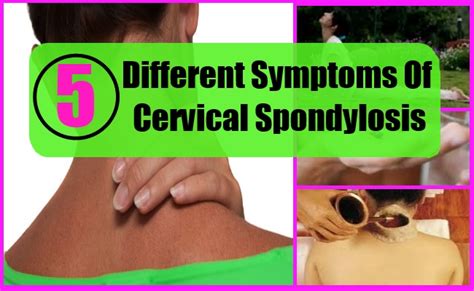 5 Different Symptoms Of Cervical Spondylosis How To Identify Symptoms