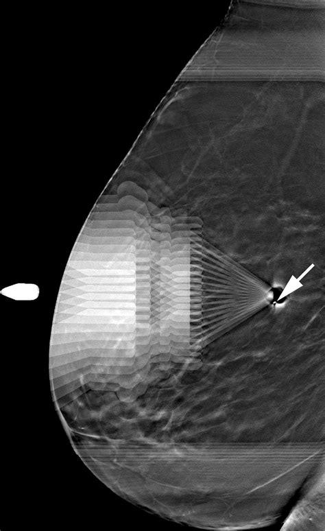 Comparison Of Upright Digital Breast Tomosynthesisguided Versus Prone