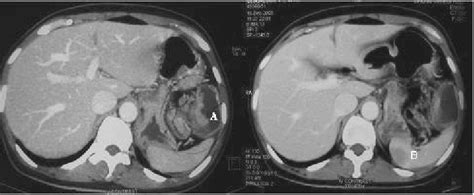 Ct Scan Of Abdomen Showing Tumor At Splenic Flexure A