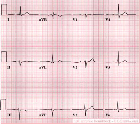 Qrs Axis Ecgpedia