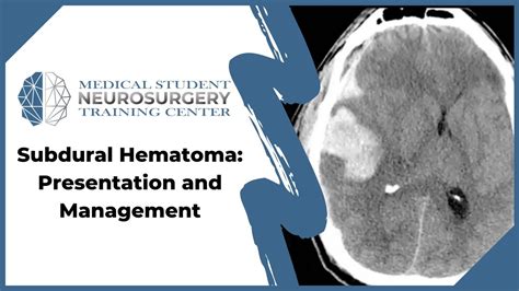 Subdural Hematoma Presentation And Management Youtube