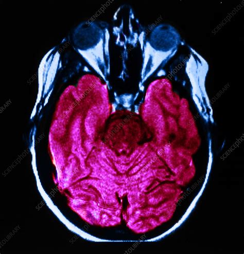 Mri Of Normal Brain Stock Image C0271019 Science Photo Library