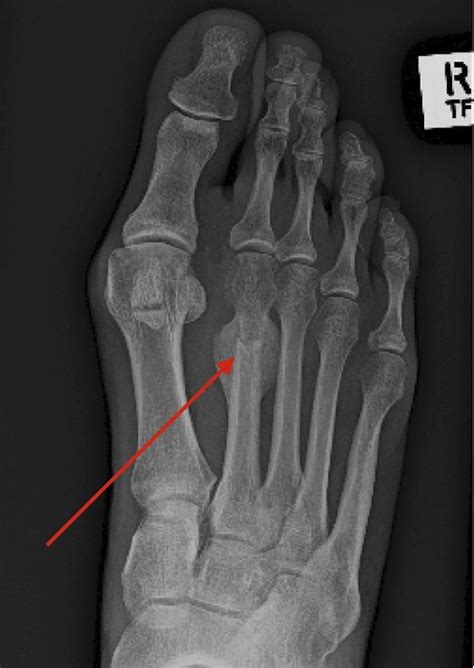 Metatarsal Stress Fracture X Ray Sexiezpix Web Porn