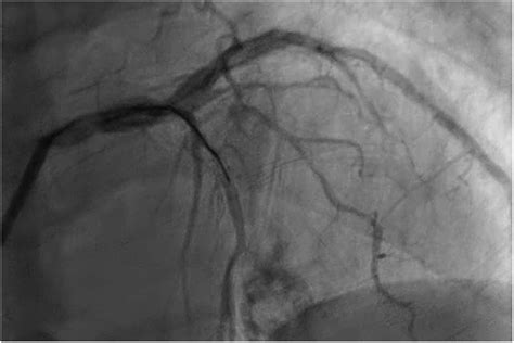 Tctap C 060 Coronary Perforation Sealed With Fat Embolization Journal