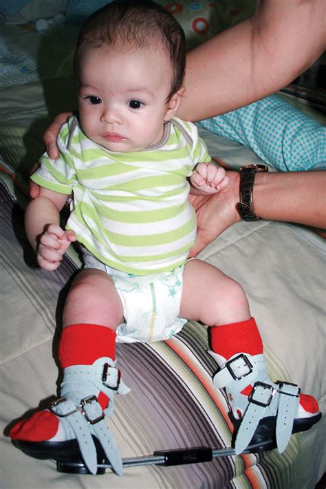 Clubfoot is a congenital deformity of the foot which ranges from mild to severe. Gait analysis for clubfoot may reveal long-term issues ...