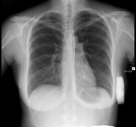 Subcutaneous Icd Chest X Ray The Best Porn Website