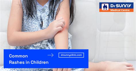 Common Rashes In Children Dr Sunny Medical Centre