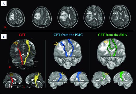 Patient Who Shows Injuries For The Corticospinal Tract Cst And