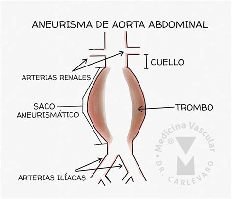 Indicaciones De Tratamiento En El Aneurismas De Aorta Abdominal