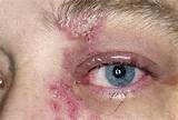 Facial Seborrheic Dermatitis Home Remedies Pictures
