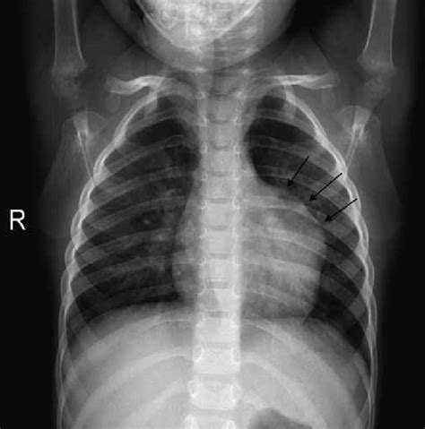 Chest Radiography Shows Enlargement Of The Left Heart Border At The