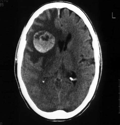 Single Brain Metastases From Epithelial Ovarian Cancer Download