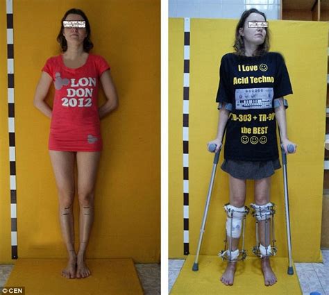 Aspiring Model Told She Was Too Short Has Her Legs Surgically