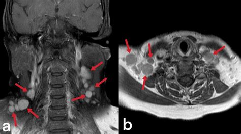 Tuberculous Cervical Lymphadenitis Pacs