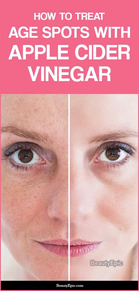 How To Treat Age Spots With Apple Cider Vinegar