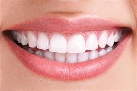 Teeth Whitening - Smile Dental Care
