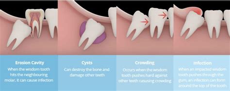 How Wisdom Tooth Extraction Affects Your Weight Exploring The Impact