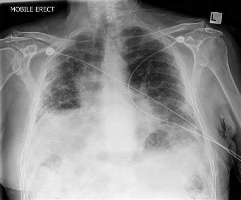 Idiopathic Pulmonary Fibrosis Chest X Ray