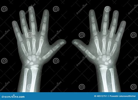 X Ray Both Child Hands On Black Background Stock Image Image Of Joint