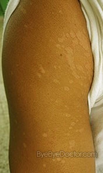 White Spots On Skin 8211 Causes Symptoms Causes Treatment And