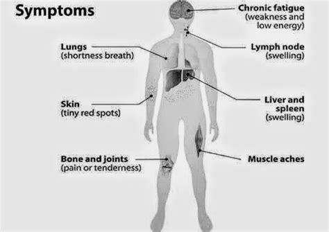 Sign And Symptoms Of Hodgkins Lymphoma Pt Master Guide Pt Master Guide