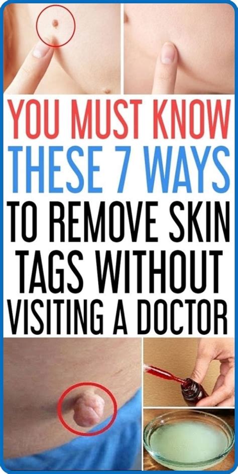 7 easy ways to remove skin tags without visiting a doctor skin tag removal skin tag natural