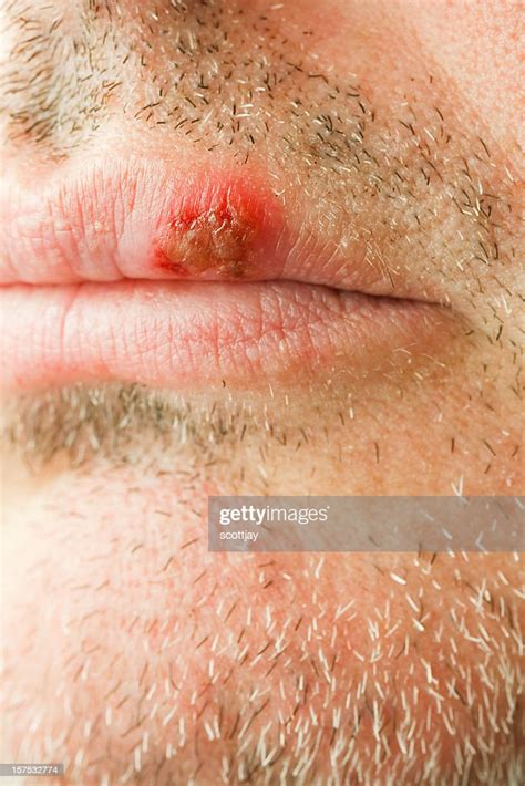 Cold Sore On The Lip Of A Middle Aged Male High Res Stock Photo Getty
