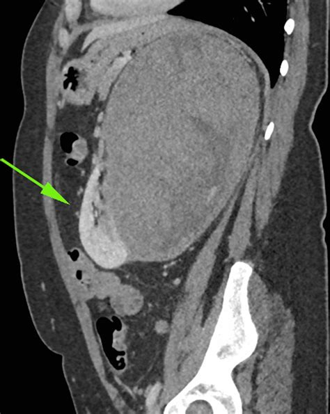 Adult Wilms Tumour An Illustration Of Multimodality Imaging