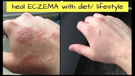 The Perfect Day Of Eczema Dermatitis Psoriasis Rosacea Healing