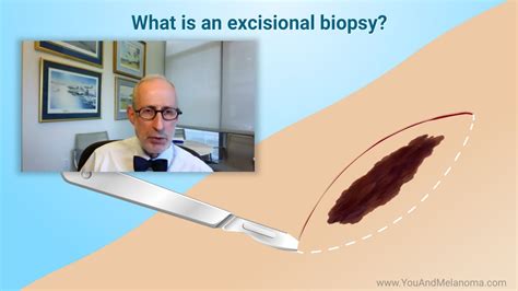 What Kind Of Biopsies Are Used For Melanoma Youtube