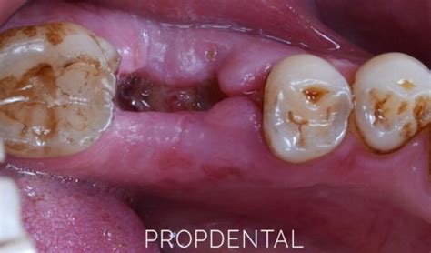 Los Signos De Una Infección Después De Una Extracción Dental Irrigadores Dentales