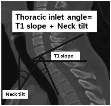 The Sum Of Thoracic Inlet Outlet Angle Is The Angle Of T1 Slope And