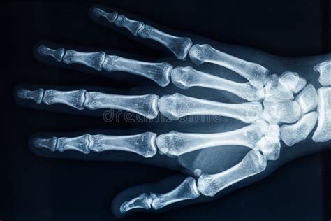 Hand Bone Anatomy X Ray